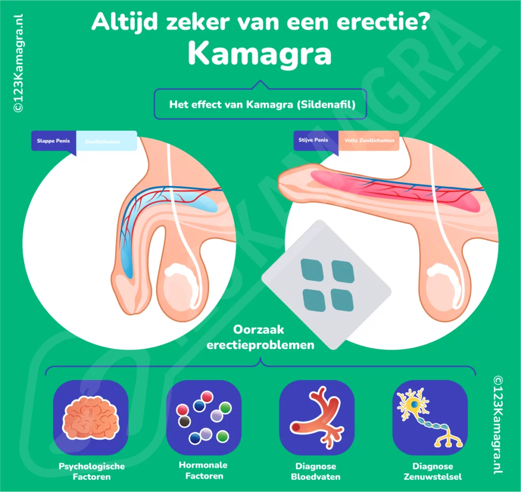Infographic - Erectieproblemen - Kamagra - Sildenafil erectiepillen